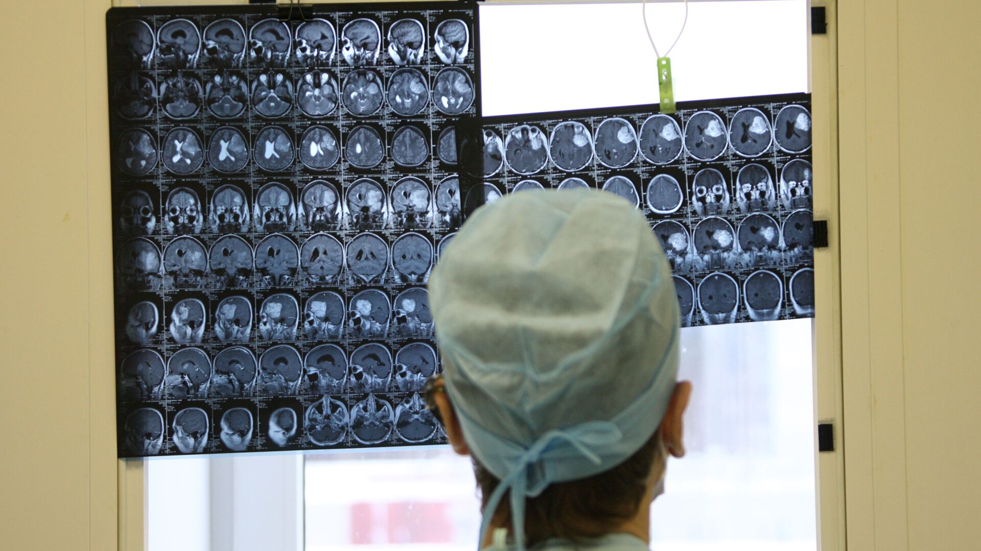 Врач смотрит на рентген снимки мозга. Архивное фото - Sputnik Таджикистан, 1920, 13.05.2021