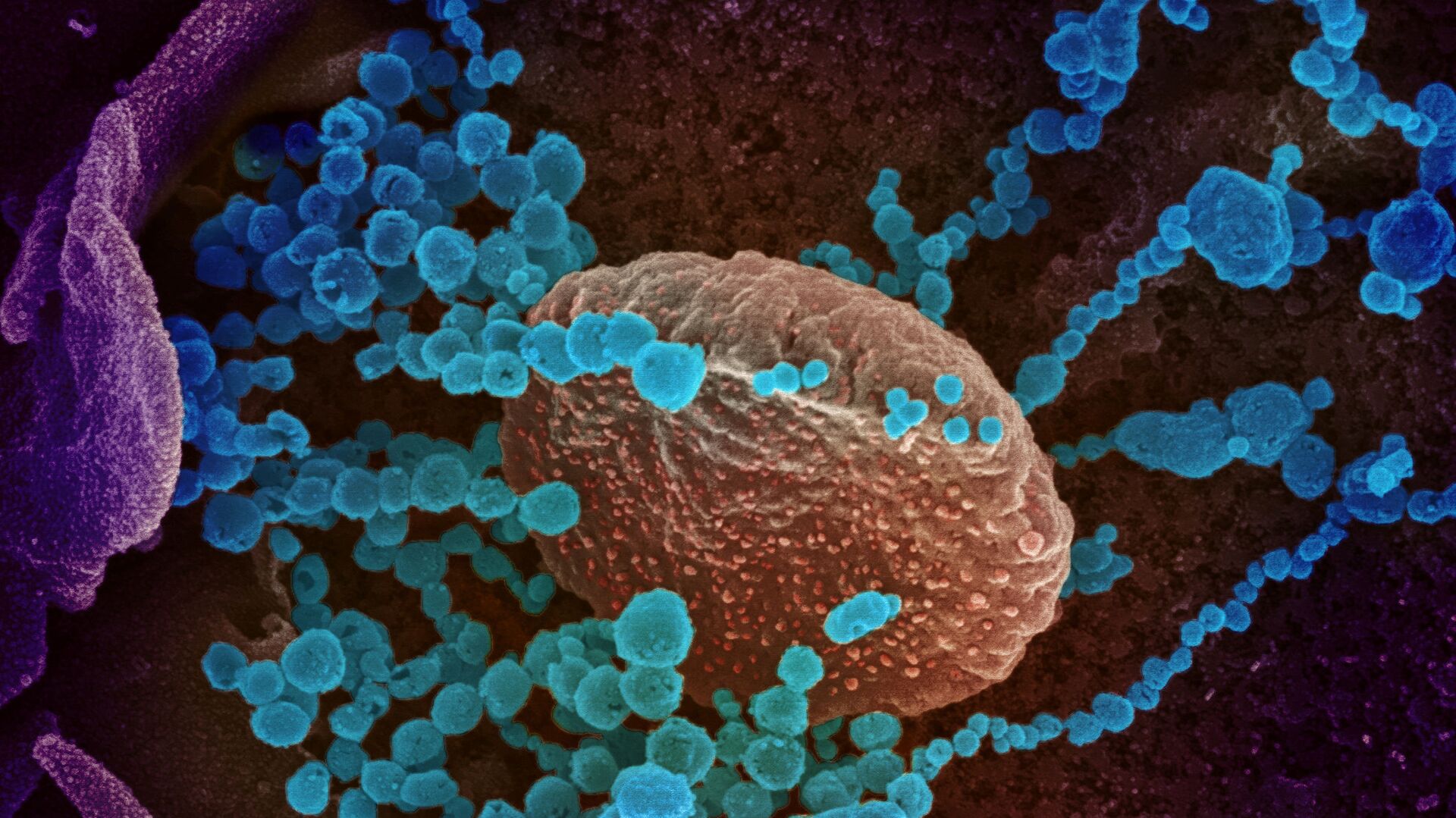 Вид на зараженную коронавирусом  клетку под микроскопом  - Sputnik Таджикистан, 1920, 23.02.2021